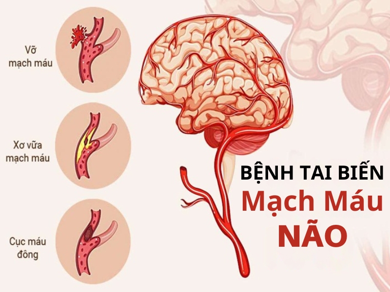 Bệnh tai biến mạch máu não