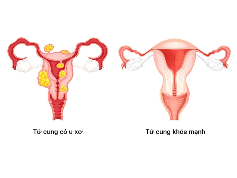 Bệnh u xơ tử cung