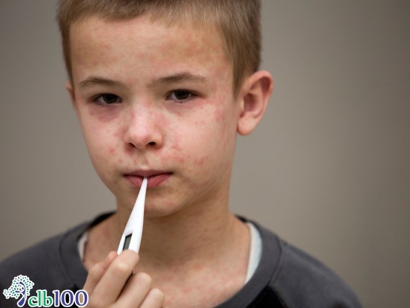 Nhận diện các triệu chứng bệnh quai bị