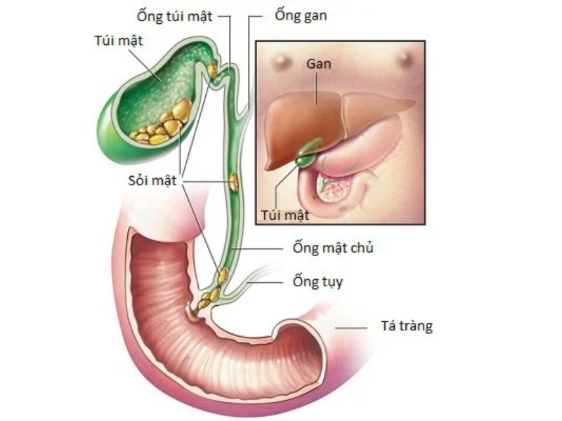 Tình trạng sỏi rơi vào ống dẫn mật