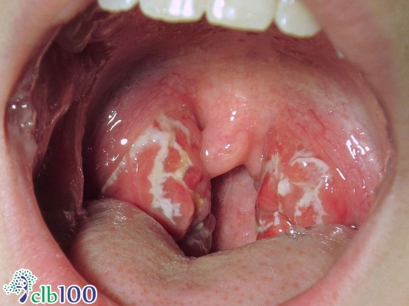 Vì sao viêm amidan dễ tái phát và kéo dài?