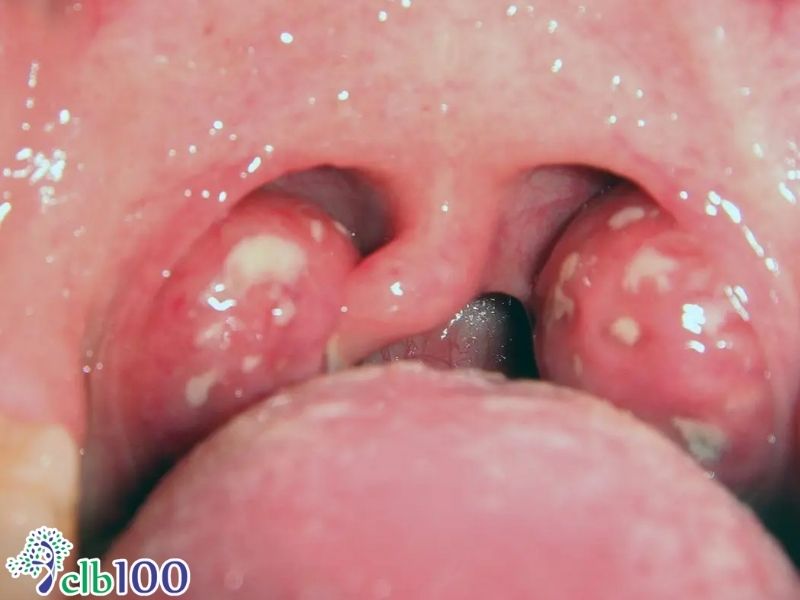 Viêm amidan hốc mủ là gì?