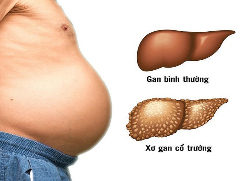 Xơ gan cổ trướng là bệnh gì?