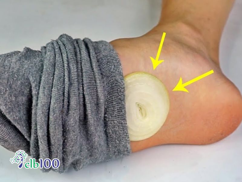 Đắp củ hành tây dưới lòng 2 bàn chân