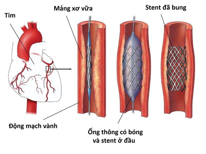 Những hạn chế khi đặt stent