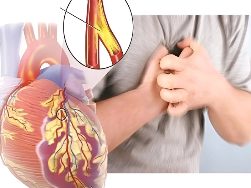 Tại sao mạch máu bị tắc nghẽn?