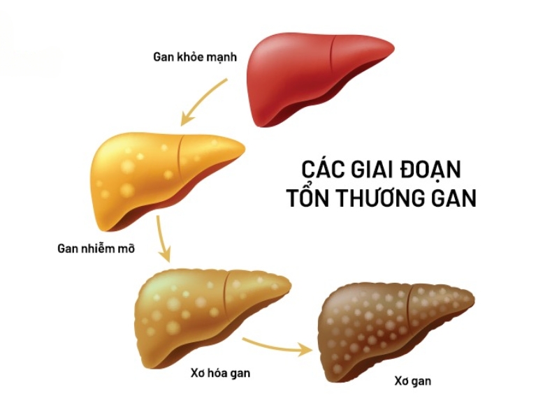 Các giai đoạn của bệnh gan