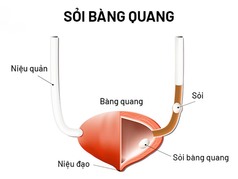 Bệnh bàng quang