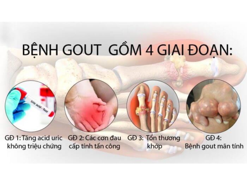 Bệnh gout