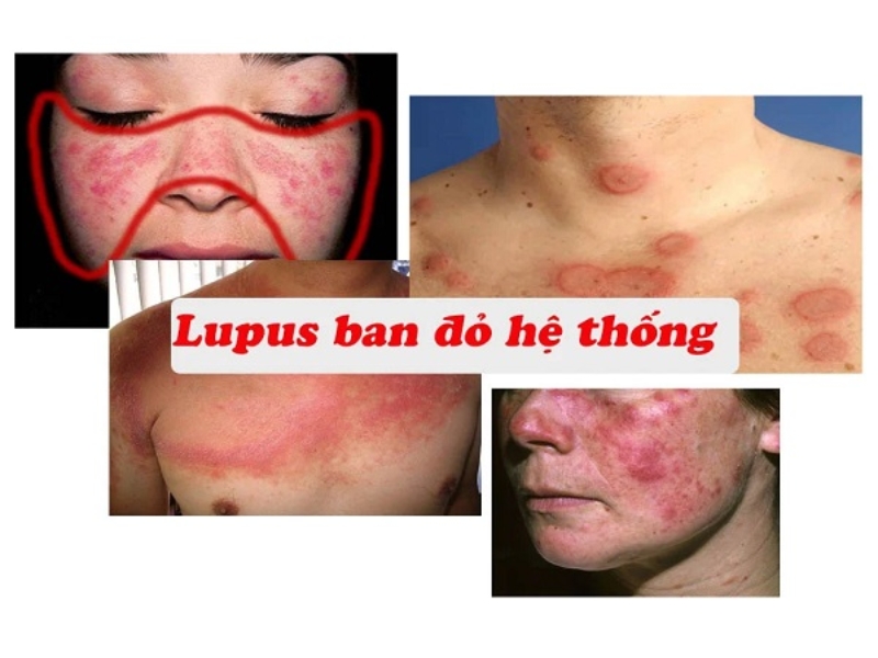 Bệnh lupus ban đỏ là gì?