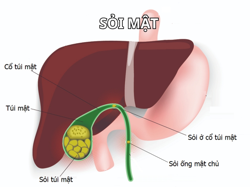 Bệnh sỏi mật