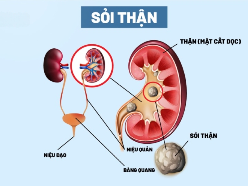 Bệnh sỏi thận