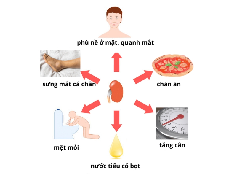 Các triệu chứng của hội chứng hư thận