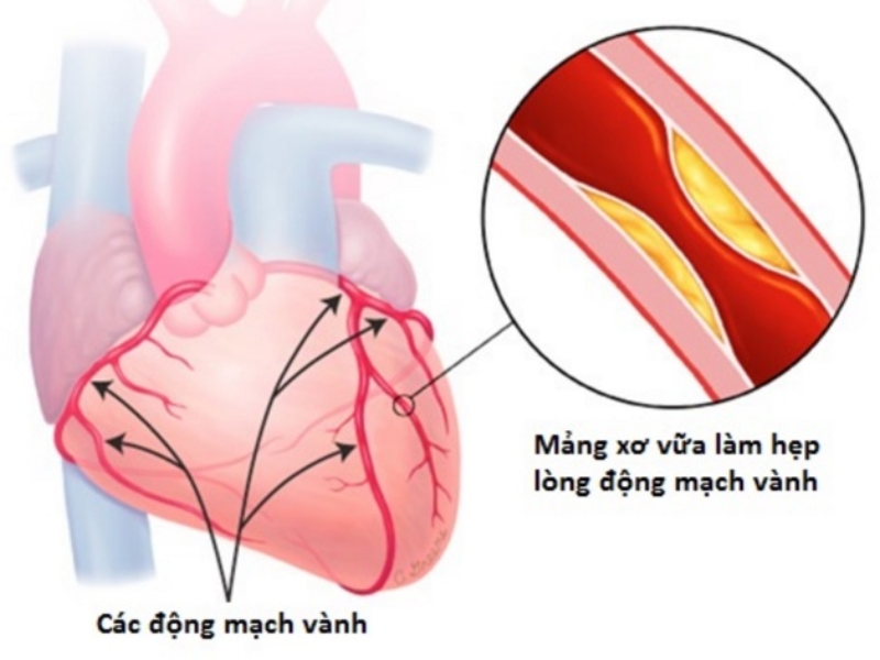 Nguyên nhân mắc bệnh tim mạch