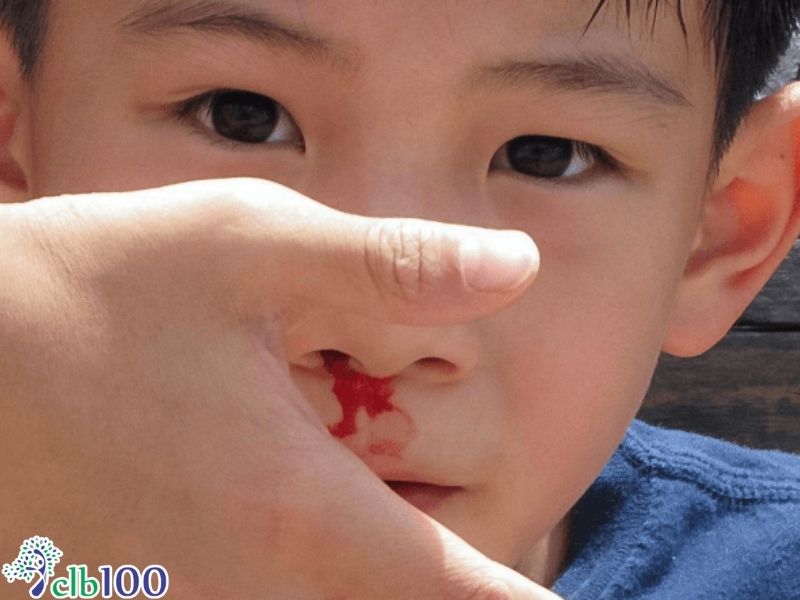 Nguyên nhân trẻ hay bị chảy máu cam theo tây y