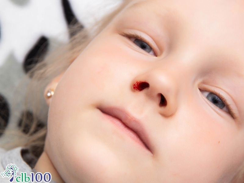 Tuyệt đối không ngửa đầu ra sau khi bị chảy máu cam