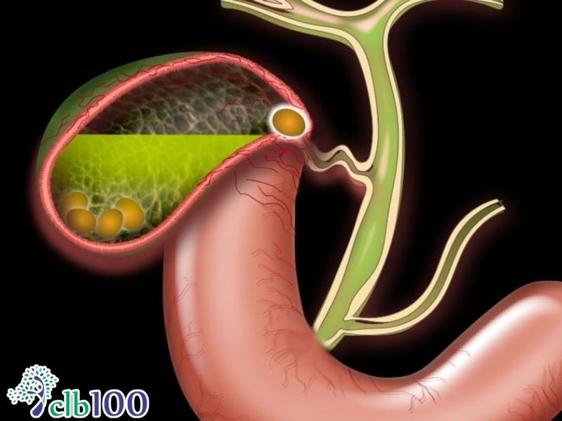 Các biến chứng nguy hiểm nếu không điều trị sỏi mật kịp thời