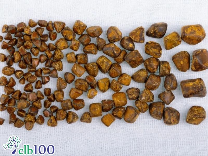 Các nhóm có nguy cơ dễ mắc bệnh sỏi mật