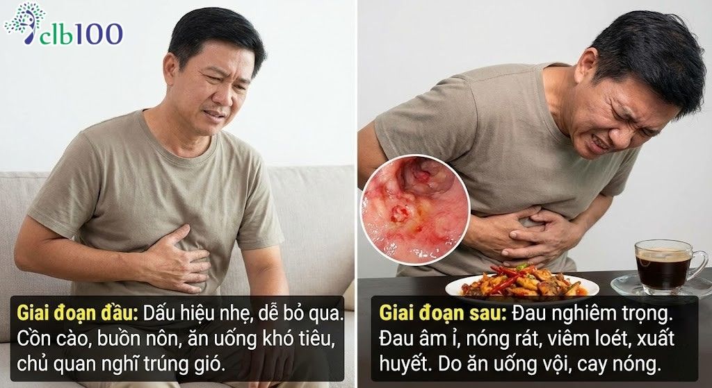 Dấu hiệu của đau bao tử dễ bị bỏ qua