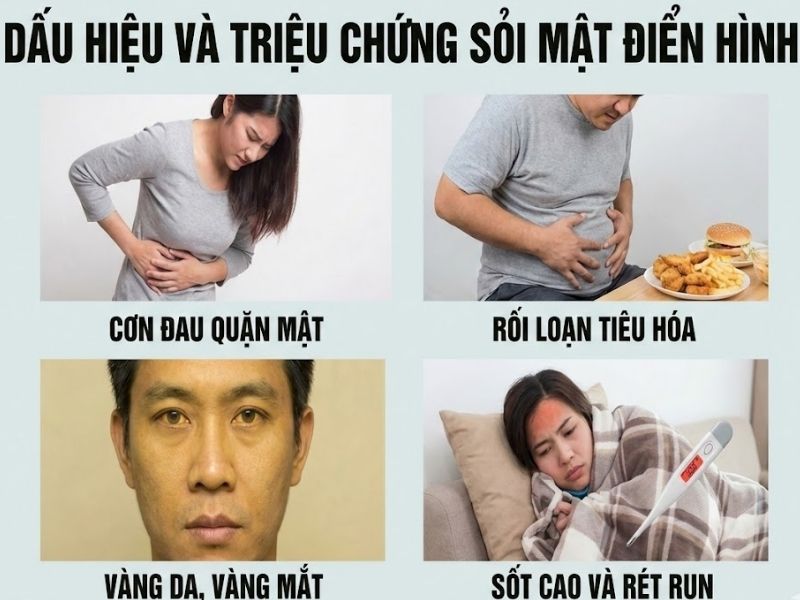 Dấu hiệu và triệu chứng sỏi mật điển hình