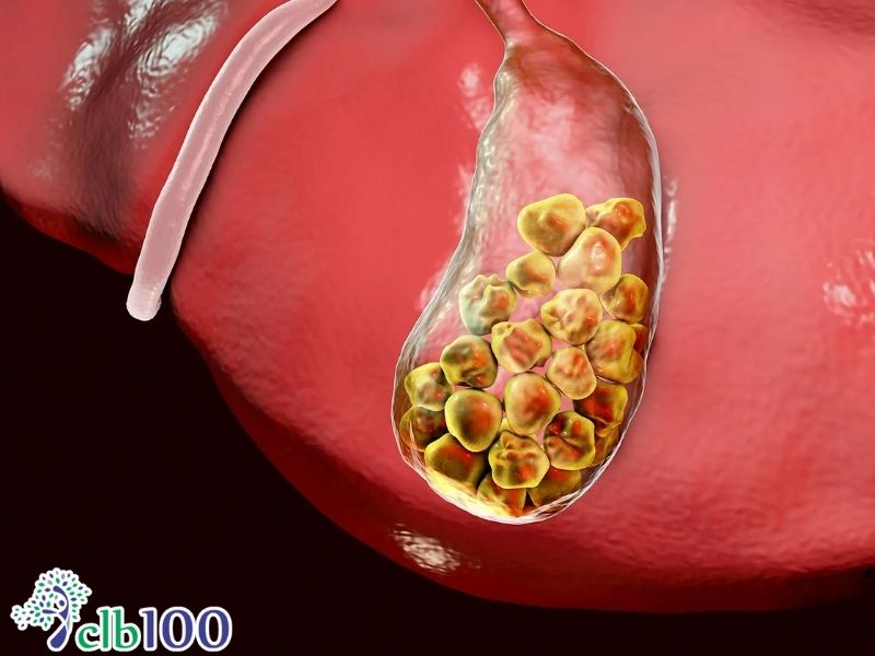 Tổng quan về bệnh sỏi mật
