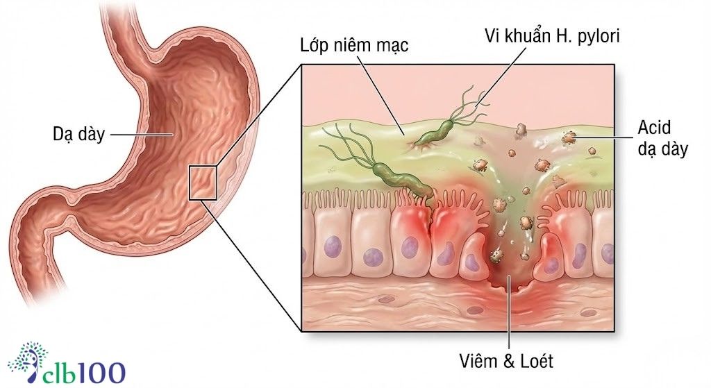 Vi khuẩn Helicobacter pylori (H. pylori), nguyên nhân gây đau bao tử