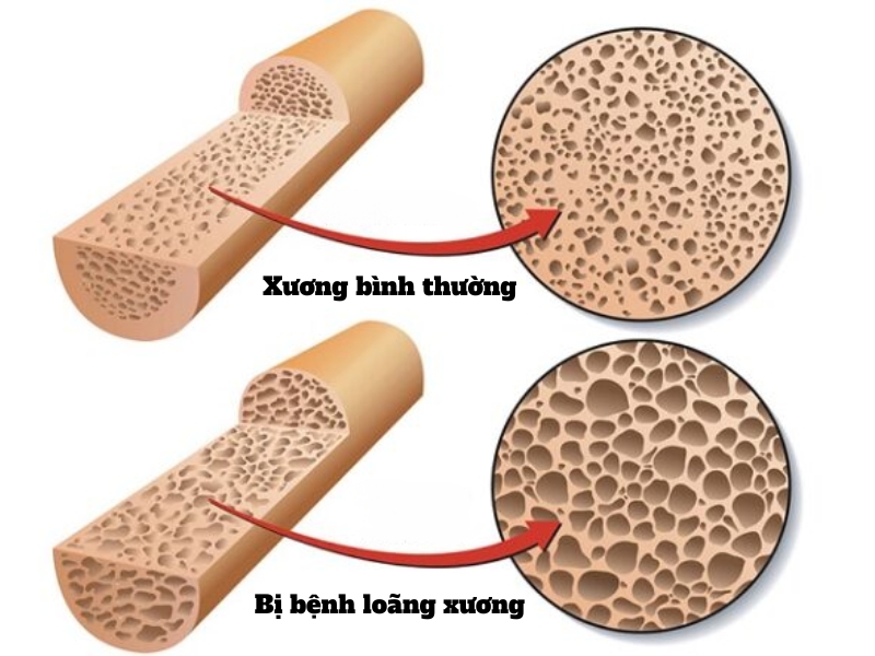 Bệnh loãng xương là gì?