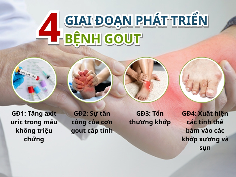 Dấu hiệu bệnh gout theo từng giai đoạn