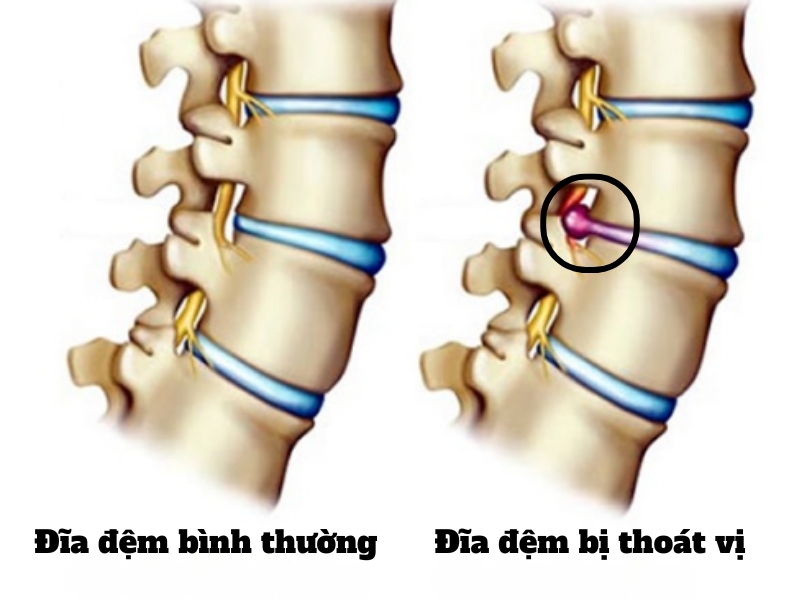 Tìm hiểu về bệnh thoát vị đĩa đệm