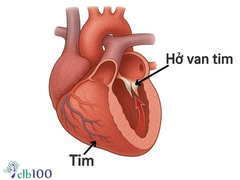 Các bệnh lý tim mạch và chuyển hoá bệnh suy tim theo Tây y