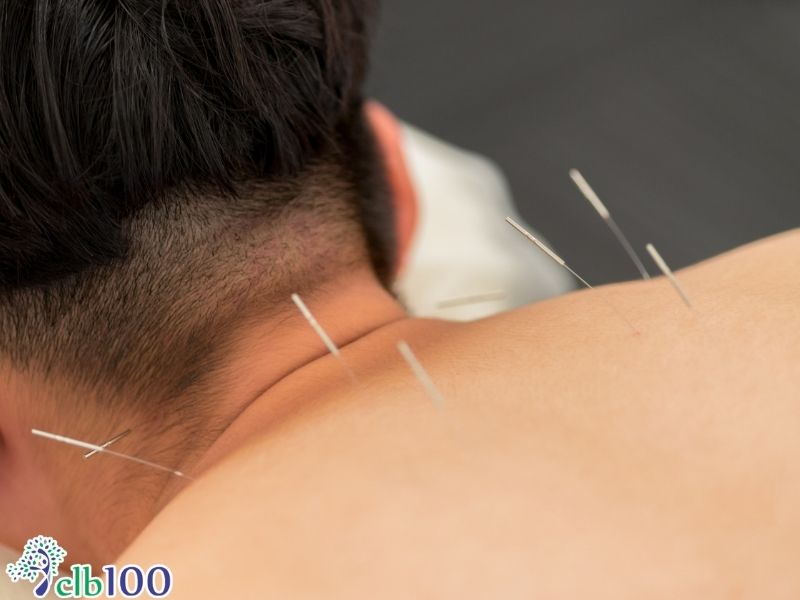 Châm cứu chữa bệnh gì? Chỉ định y khoa từ Tổ chức Y tế Thế giới (WHO)