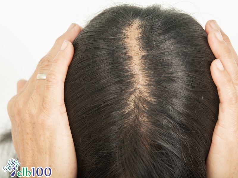 Dị ứng da đầu và hội chứng tự miễn xương khớp do sử dụng thuốc nhuộm