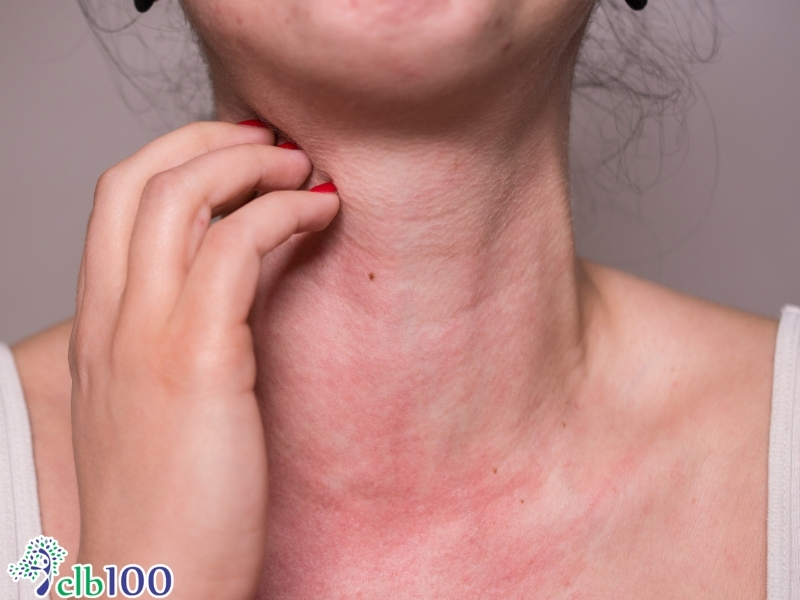 Hiện tượng dị ứng, ngứa tâm ran khi ăn súp cá chép