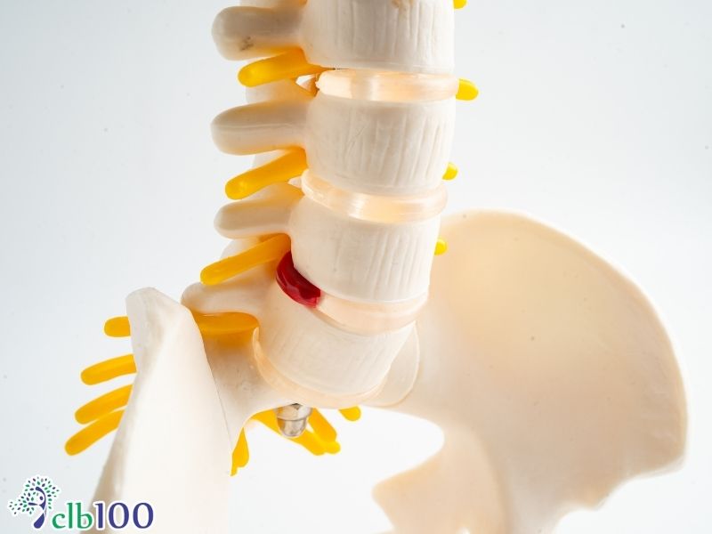 Hiểu đúng về thoát vị đĩa đệm và các giai đoạn tiến triển