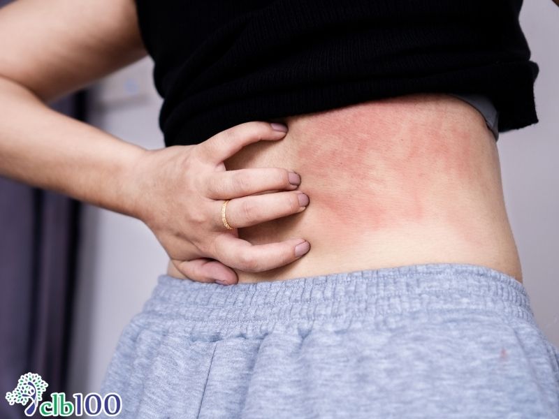 Dấu hiệu nhận biết của dị ứng thực phẩm là gì?