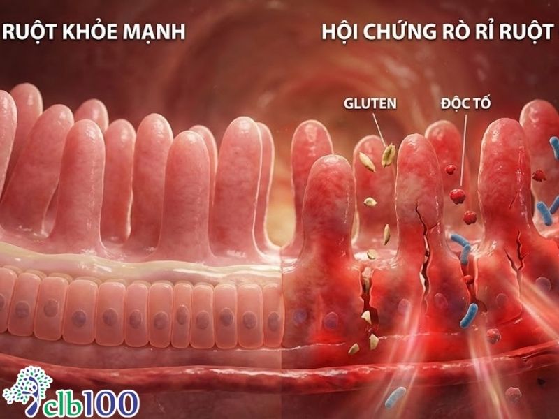 Mối nguy hại tiềm ẩn của Gluten