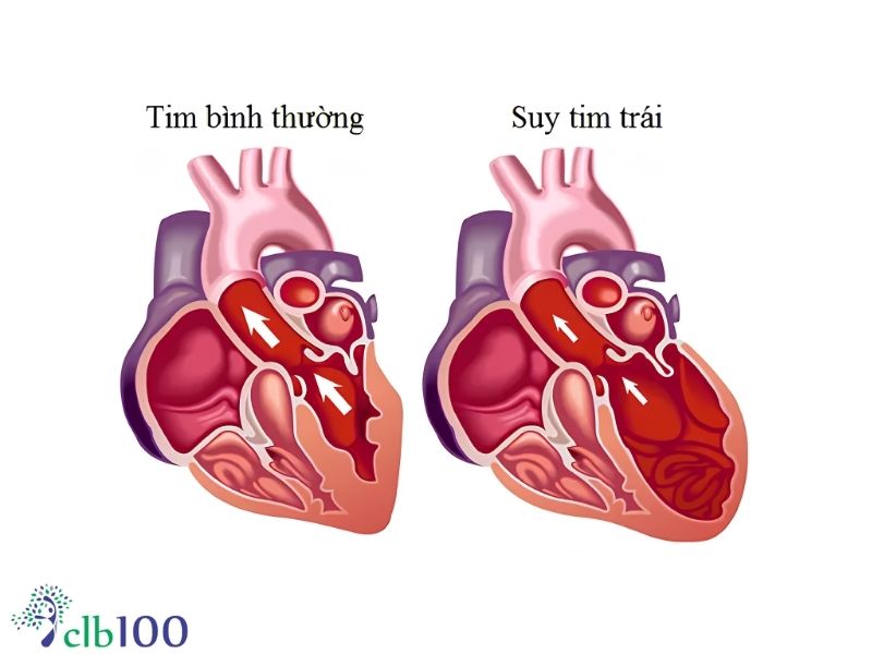 Phân loại bệnh suy tim theo cấu trúc và chức năng tim