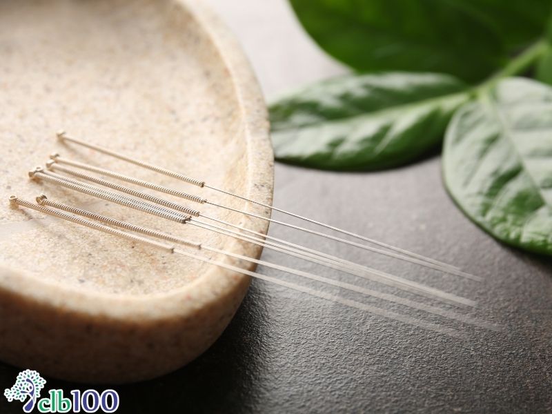 Quy trình châm cứu chuẩn y khoa của Bộ Y Tế