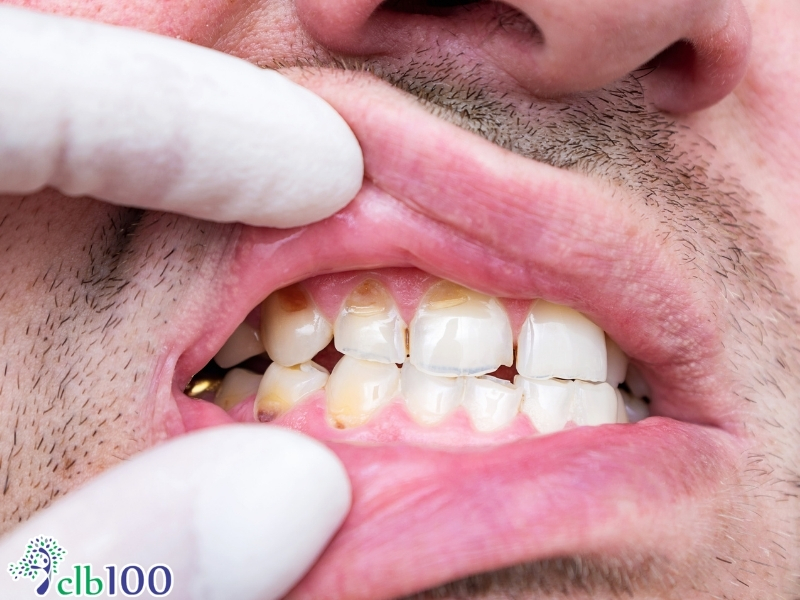 Nước đá lạnh gây huỷ hoại cấu trúc men răng vĩnh viễn