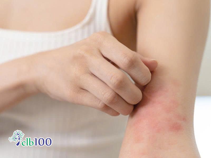 Đắp cao khoai sọ bị ngứa phải làm sao?