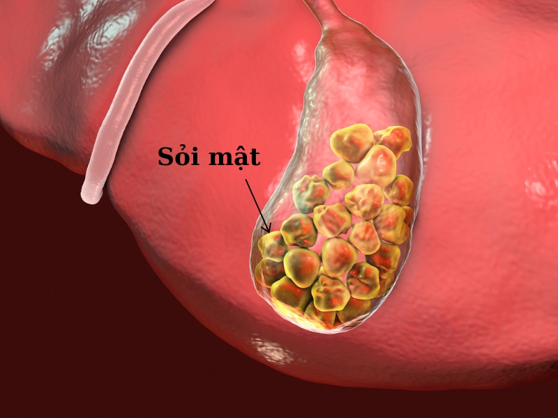 Nguyên nhân hình thành sỏi mật