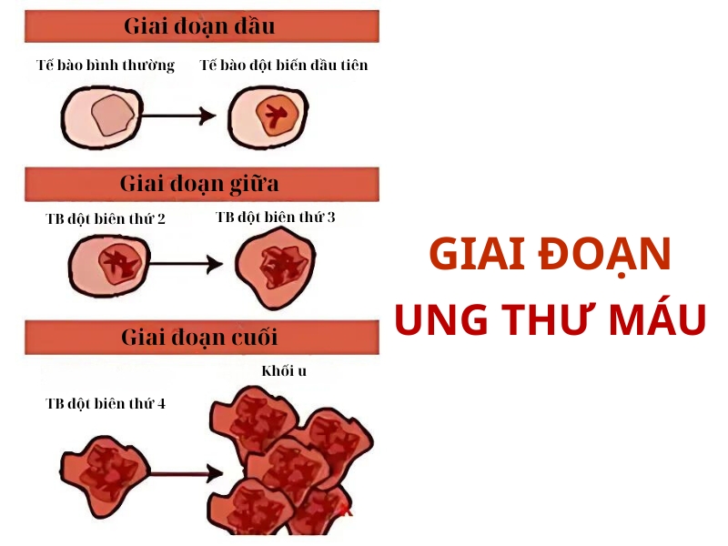 Nguyên nhân mắc bệnh ung thư máu