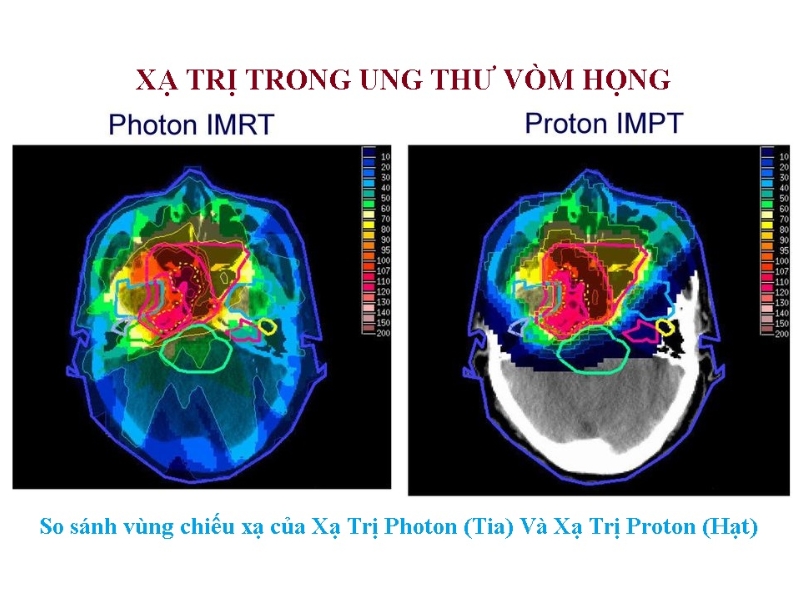 Xạ trị trong