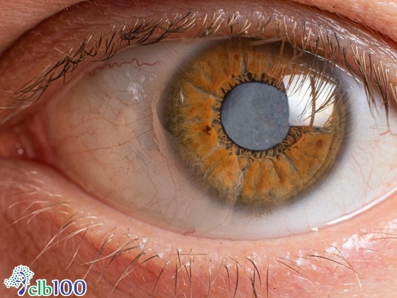 Dấu hiệu quả cườm khô (đục thuỷ tinh thể)