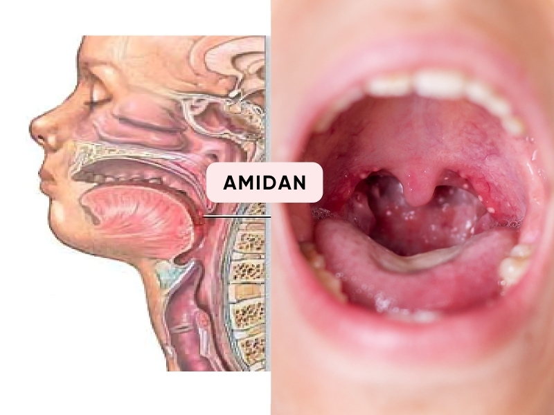 Vai trò của amidan trong hệ miễn dịch