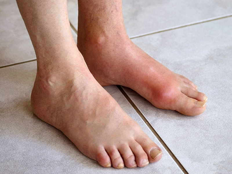 Hỗ trợ điều trị bệnh gout